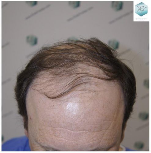 injerto de pelo