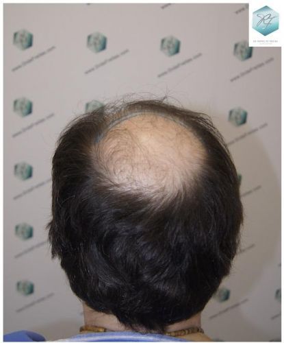 injerto de pelo