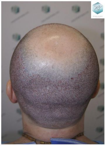injerto de pelo