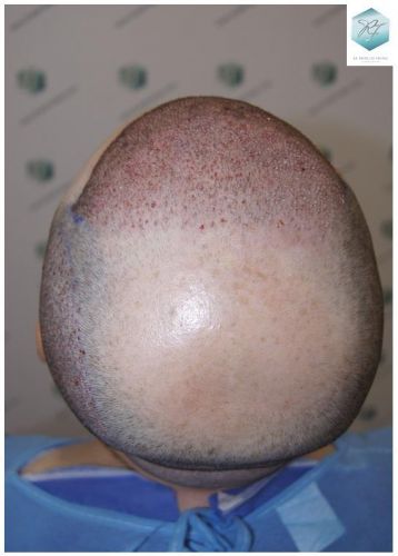 injerto de pelo