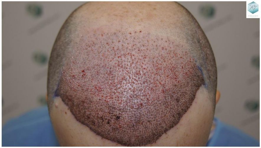 injerto de pelo
