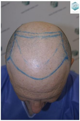 recuperar pelo coronilla