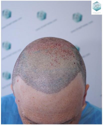 recuperar pelo coronilla