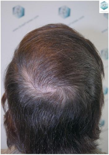 recuperar pelo coronilla