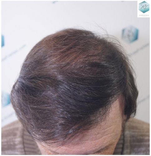 recuperar pelo coronilla