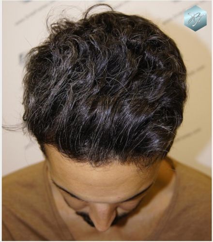 Injerto Capilar Técnica FUE Grafts 2409 (5238 Pelos) 13 resultados trasplante de pelo