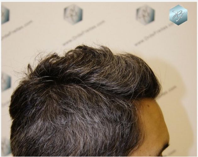 Injerto Capilar Técnica FUE Grafts 2409 (5238 Pelos) 14 implante de pelo