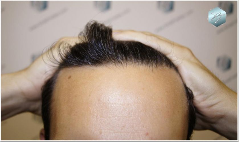 Injerto Capilar Técnica FUE Grafts 2409 (5238 Pelos) 11 implante de pelo