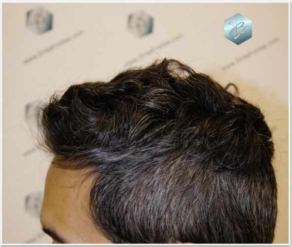 Injerto Capilar Técnica FUE Grafts 2409 (5238 Pelos) 15 implante de pelo