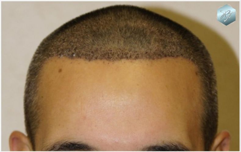 Injerto Capilar Técnica FUE Grafts 2409 (5238 Pelos) 8 implante de pelo
