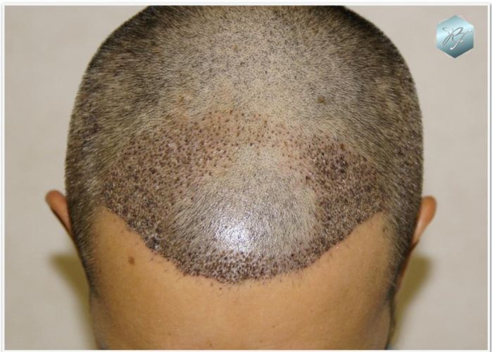 Injerto Capilar Técnica FUE Grafts 2409 (5238 Pelos) 9 implante de pelo
