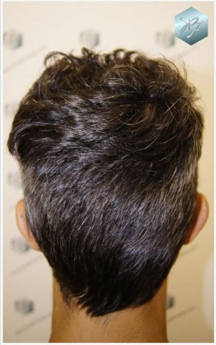 Injerto Capilar Técnica FUE Grafts 2409 (5238 Pelos) 16 implante de pelo