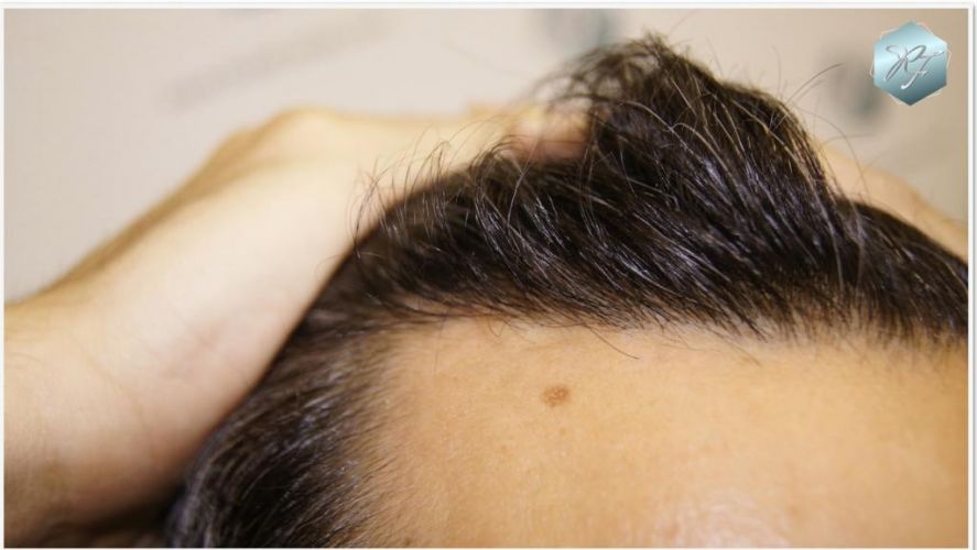 Injerto Capilar Técnica FUE Grafts 2409 (5238 Pelos) 12 implante de pelo