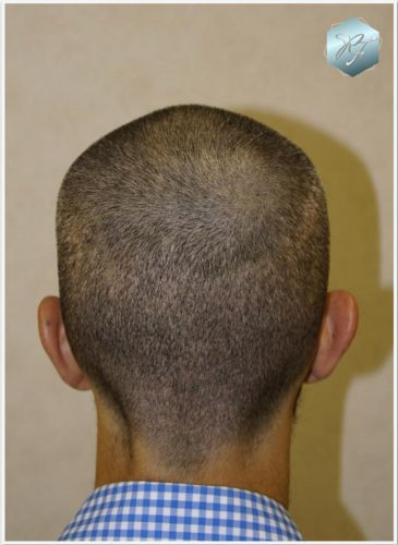 Injerto Capilar Técnica FUE Grafts 2409 (5238 Pelos) 10 implante de pelo