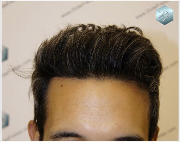 RESULTADOS A LOS 12 MESES implante de pelo