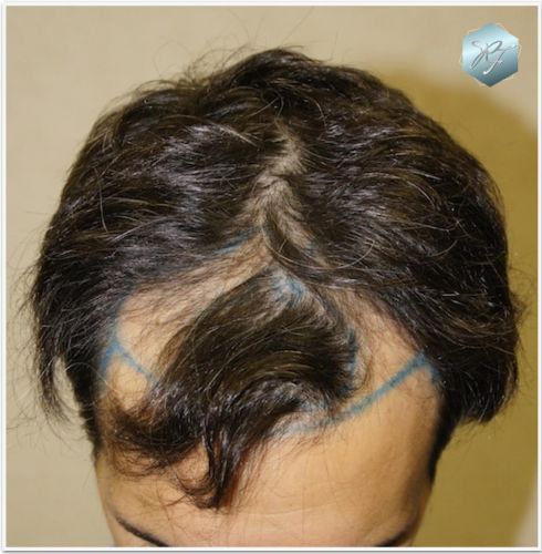 Injerto Capilar Técnica FUE Grafts 2409 (5238 Pelos) 1 injerto capilar