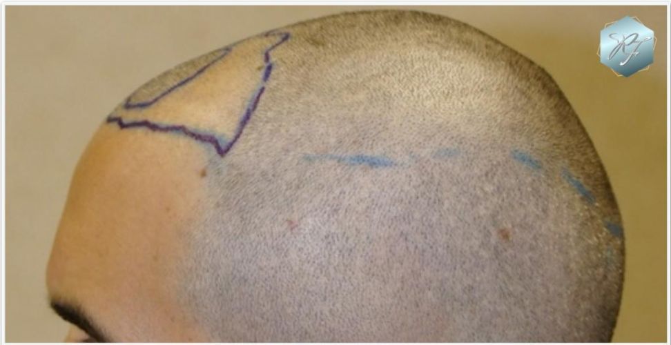 Injerto Capilar Técnica FUE Grafts 2409 (5238 Pelos) 4 injerto capilar