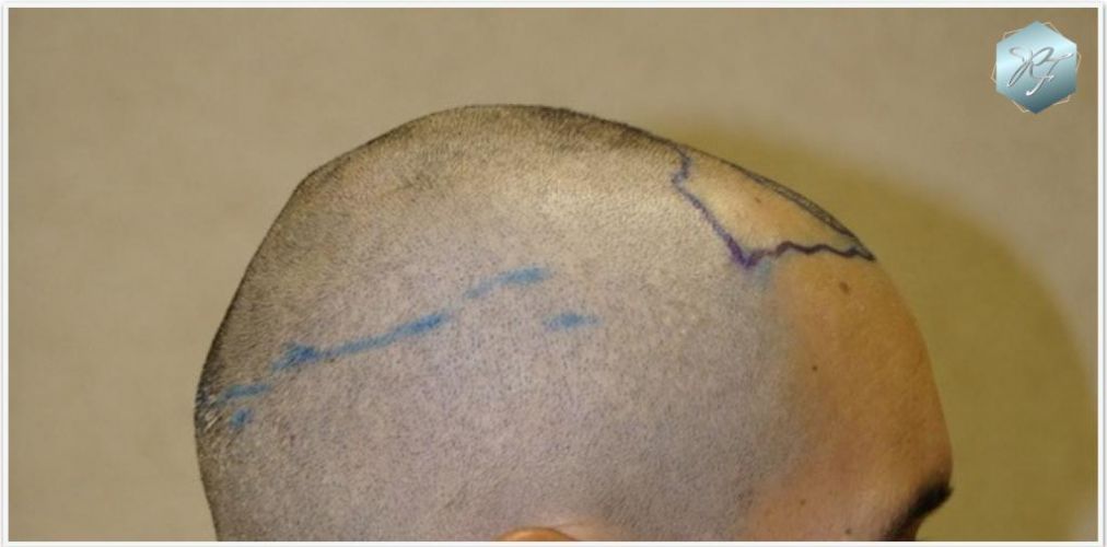 Injerto Capilar Técnica FUE Grafts 2409 (5238 Pelos) 3 resultados trasplante de pelo