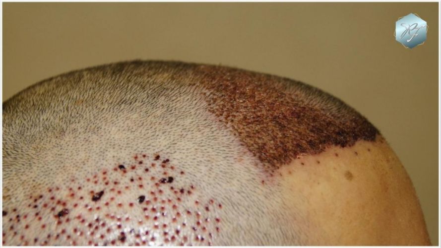 Injerto Capilar Técnica FUE Grafts 2409 (5238 Pelos) 6 resultados trasplante de pelo