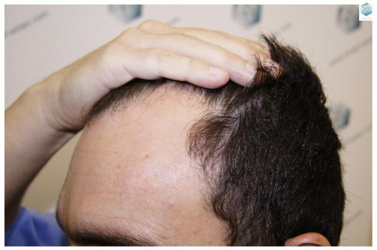 implante de pelo