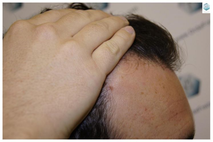 implante de pelo