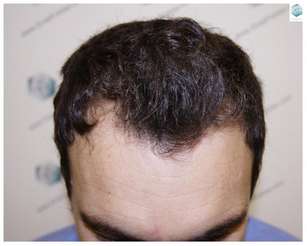 implante de pelo
