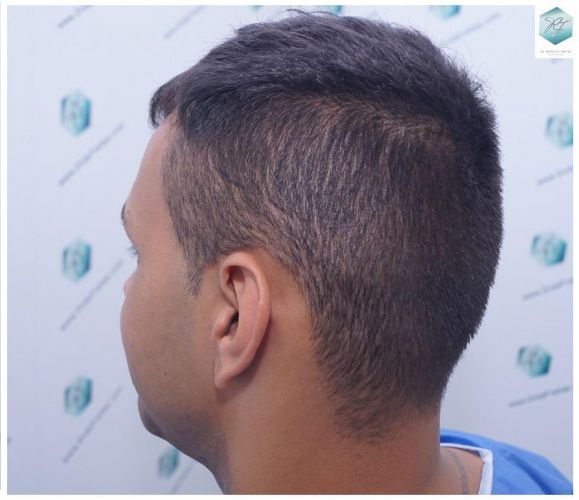 Injerto Capilar Técnica FUE 2120 Grafts (5678 Pelos) 15 injerto capilar
