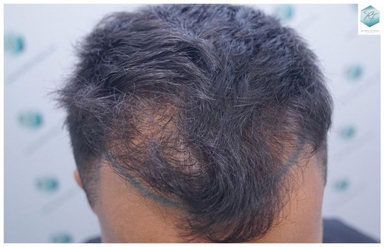 Injerto Capilar Técnica FUE 2120 Grafts (5678 Pelos) 7 injerto capilar
