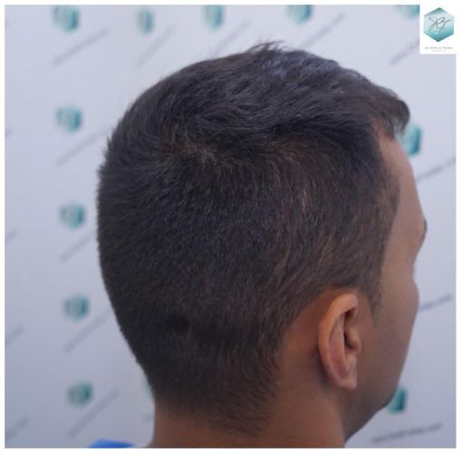 Injerto Capilar Técnica FUE 2120 Grafts (5678 Pelos) 14 injerto capilar