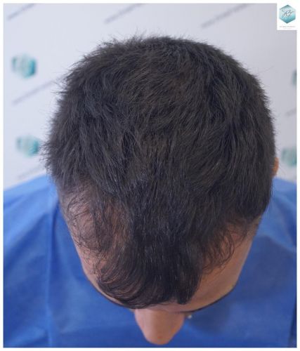 Injerto Capilar Técnica FUE 2120 Grafts (5678 Pelos) 1 injerto capilar