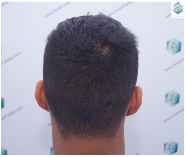 Injerto Capilar Técnica FUE 2120 Grafts (5678 Pelos) 16 injerto capilar