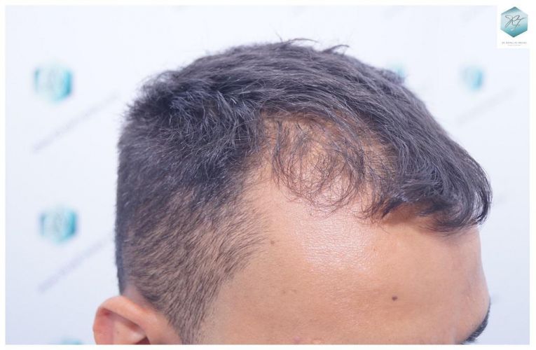 Injerto Capilar Técnica FUE 2120 Grafts (5678 Pelos) 2 injerto capilar