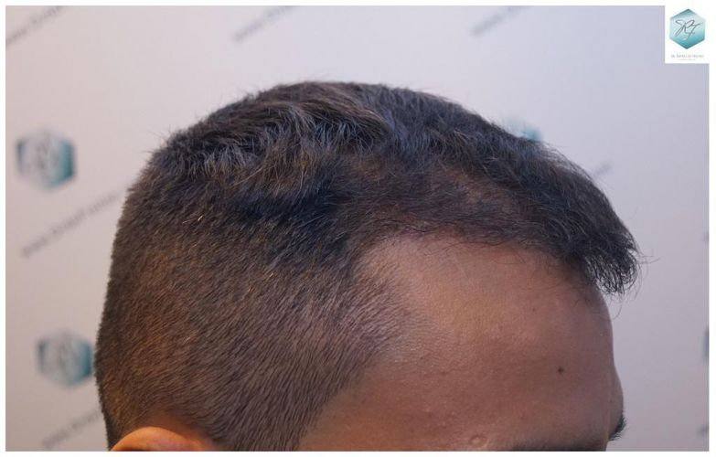 Injerto Capilar Técnica FUE 2120 Grafts (5678 Pelos) 12 trasplante de cabello