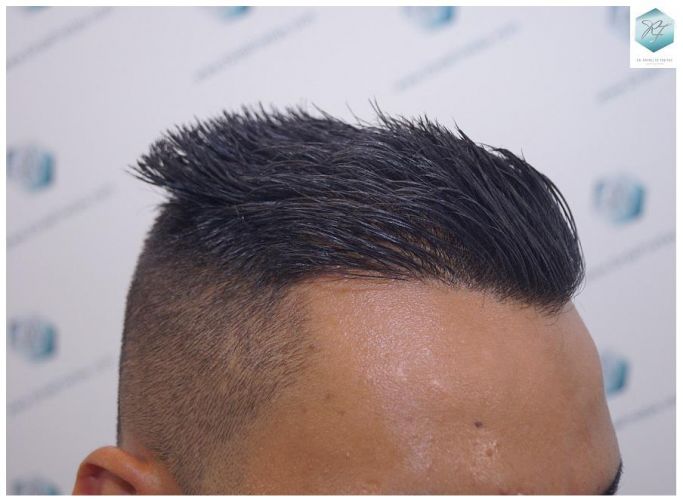 Injerto Capilar Técnica FUE 2120 Grafts (5678 Pelos) 24 trasplante de cabello