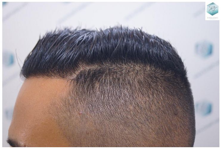 Injerto Capilar Técnica FUE 2120 Grafts (5678 Pelos) 31 trasplante de cabello