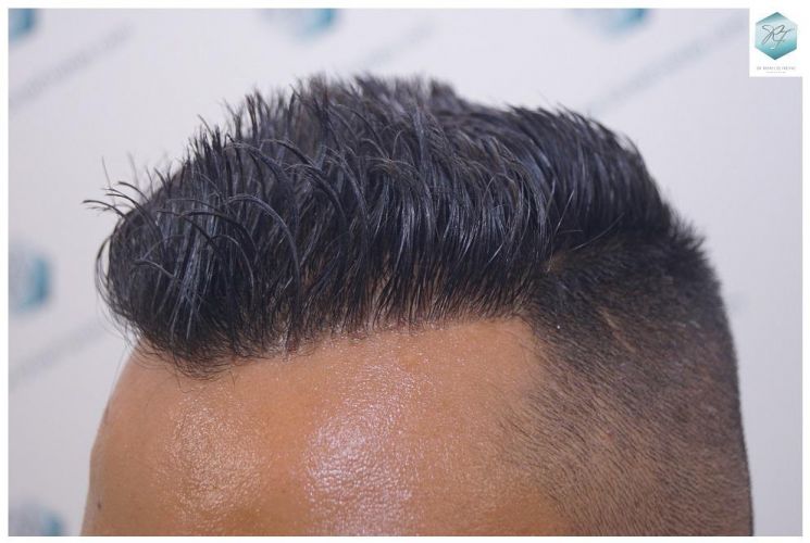 Injerto Capilar Técnica FUE 2120 Grafts (5678 Pelos) 26 trasplante de cabello