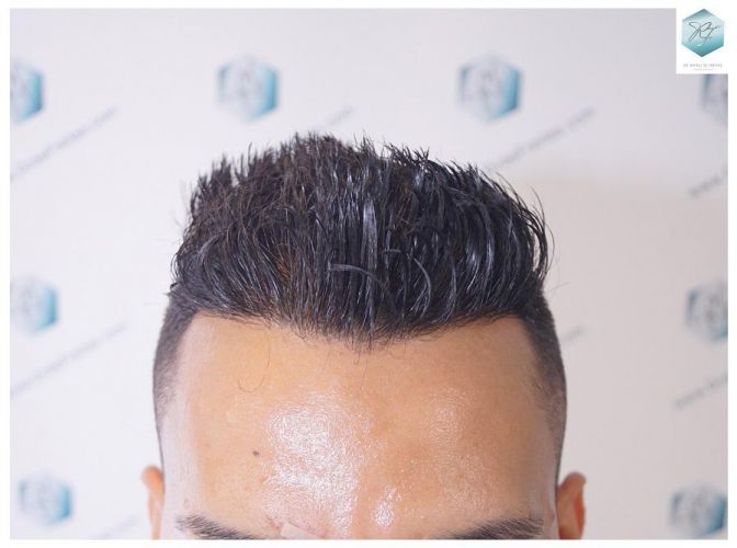 Injerto Capilar Técnica FUE 2120 Grafts (5678 Pelos) 21 trasplante de cabello