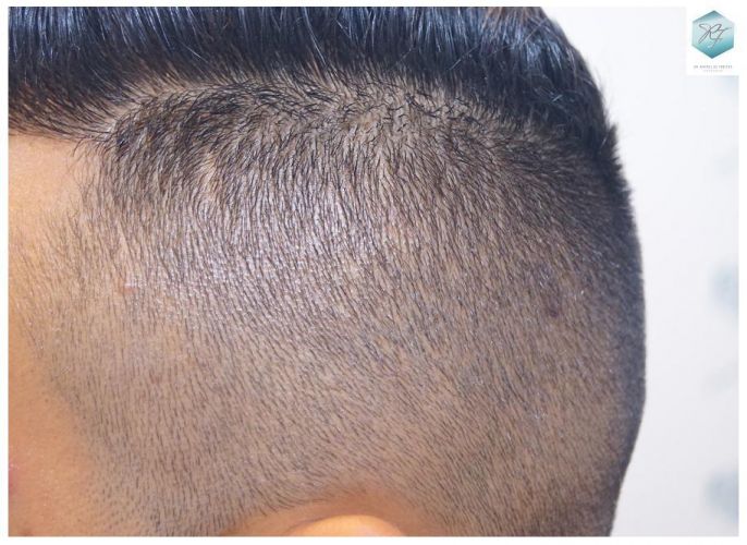 Injerto Capilar Técnica FUE 2120 Grafts (5678 Pelos) 34 trasplante de cabello