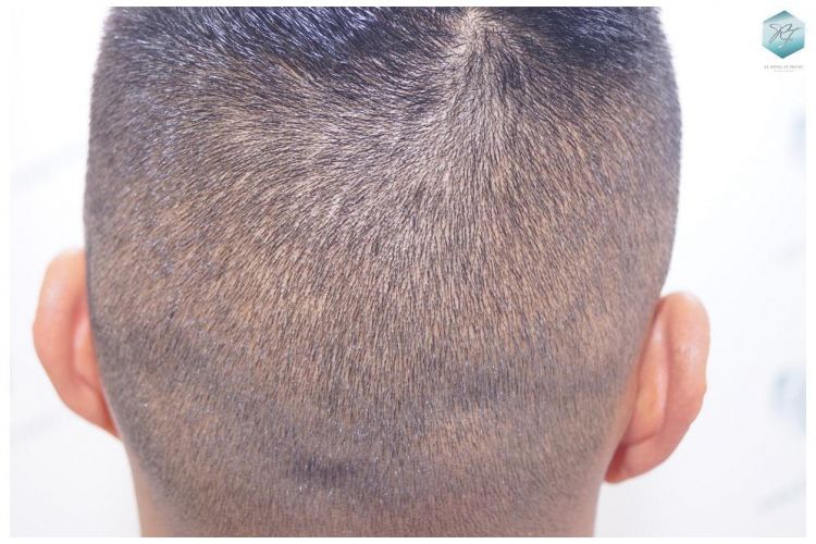 Injerto Capilar Técnica FUE 2120 Grafts (5678 Pelos) 33 trasplante de cabello