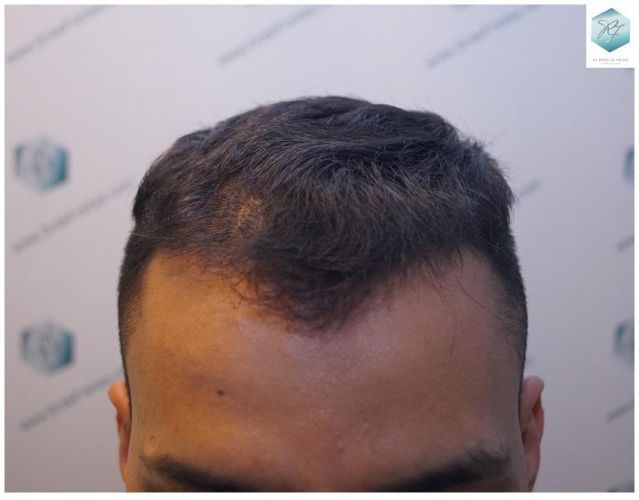 RESULTADOS A LOS 12 MESES trasplante de cabello