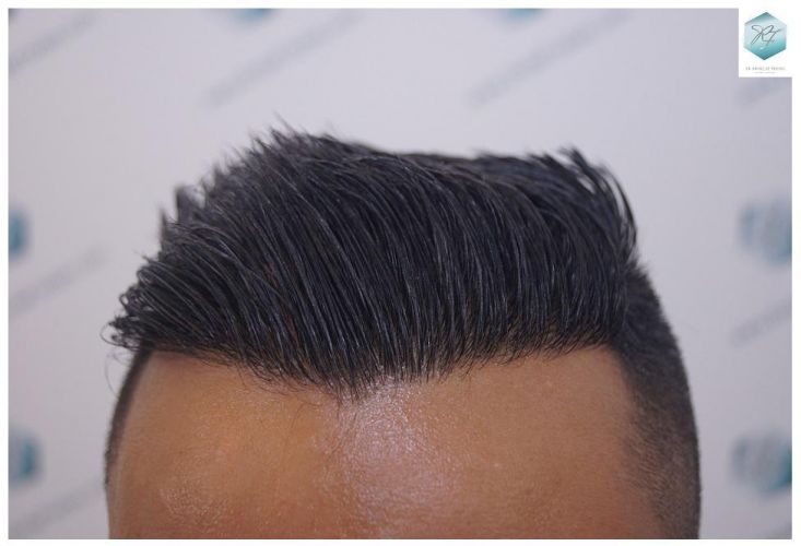 Injerto Capilar Técnica FUE 2120 Grafts (5678 Pelos) 19 trasplante de cabello