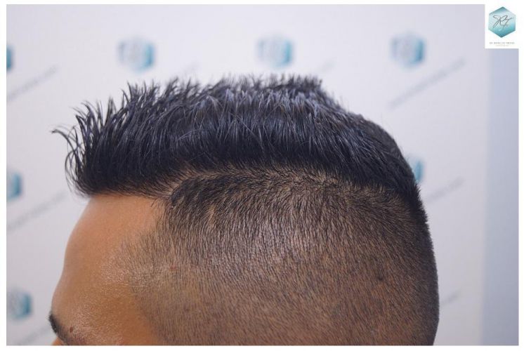 Injerto Capilar Técnica FUE 2120 Grafts (5678 Pelos) 28 trasplante de cabello