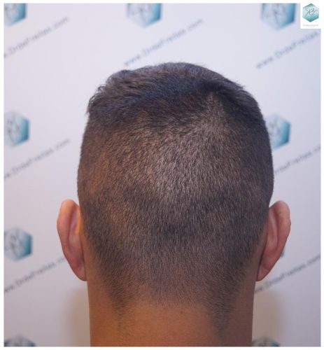 Injerto Capilar Técnica FUE 2120 Grafts (5678 Pelos) 32 trasplante de cabello