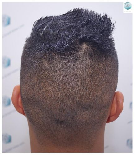 Injerto Capilar Técnica FUE 2120 Grafts (5678 Pelos) 36 trasplante de cabello
