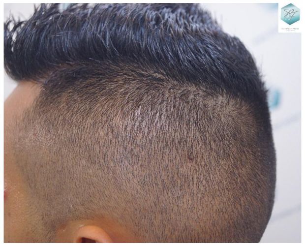 Injerto Capilar Técnica FUE 2120 Grafts (5678 Pelos) 27 trasplante de cabello