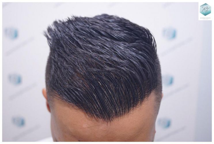 Injerto Capilar Técnica FUE 2120 Grafts (5678 Pelos) 22 evitar la caída del cabello