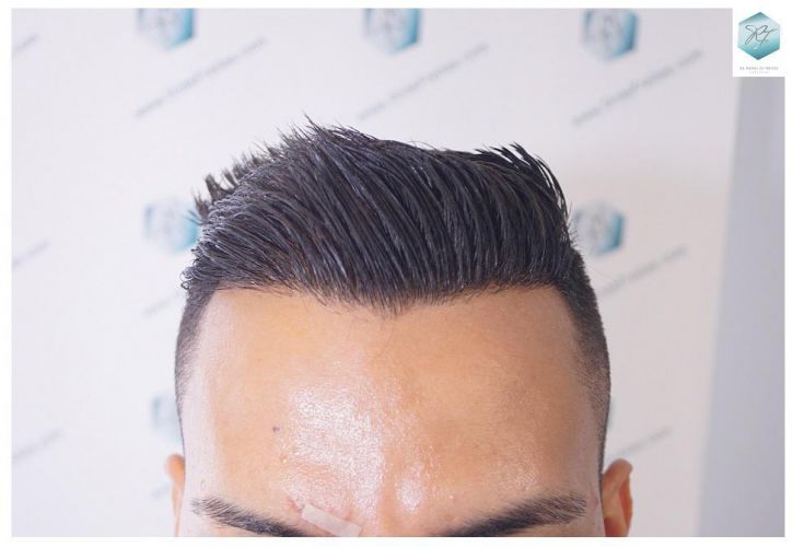 Injerto Capilar Técnica FUE 2120 Grafts (5678 Pelos) 18 evitar la caída del cabello