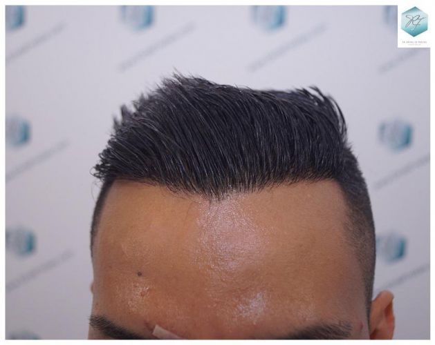 Injerto Capilar Técnica FUE 2120 Grafts (5678 Pelos) 17 evitar la caída del cabello