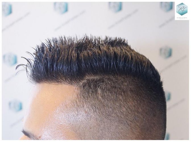 Injerto Capilar Técnica FUE 2120 Grafts (5678 Pelos) 29 trasplante de cabello