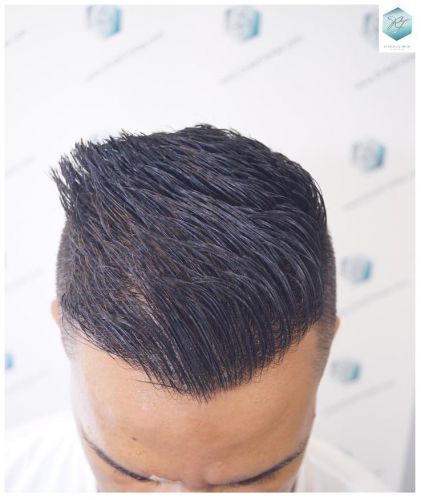 Injerto Capilar Técnica FUE 2120 Grafts (5678 Pelos) 23 trasplante de cabello